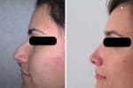 rhinoplastie