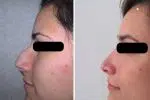 rhinoplastie