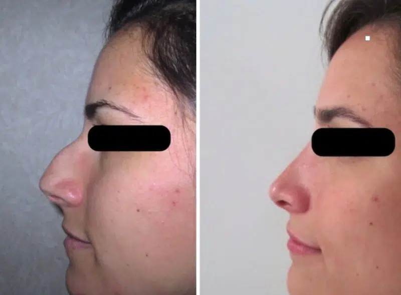 rhinoplastie